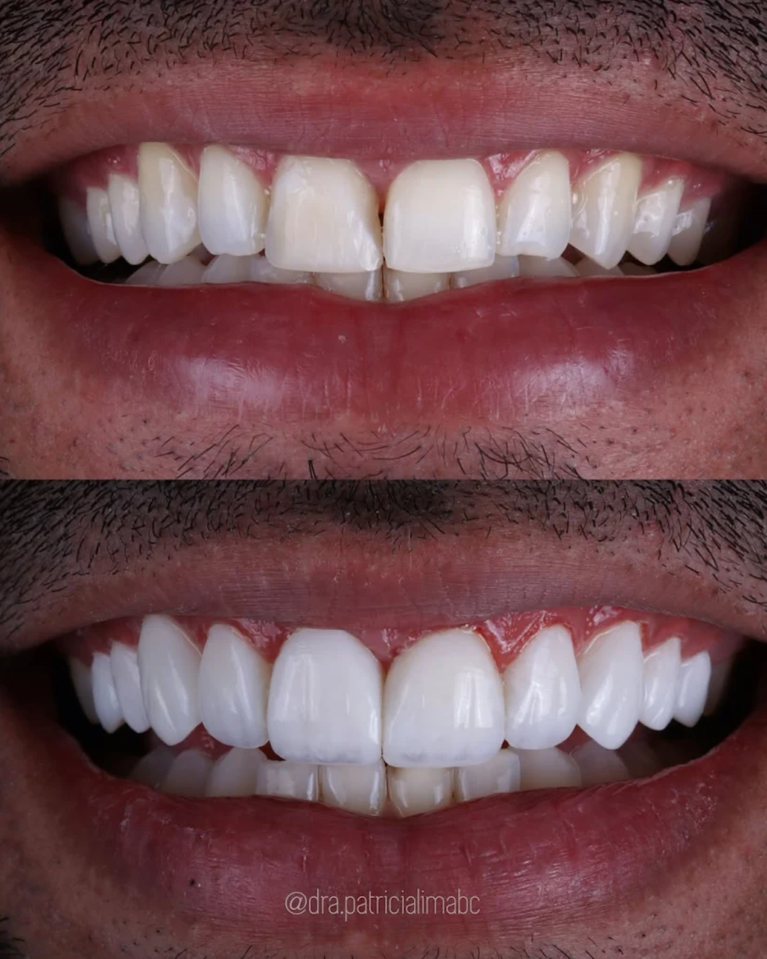 Antes e Depois 4